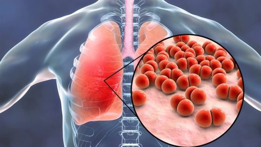 heart-attack-risk-is-considerably-increased-by-severe-pneumococcal-infection